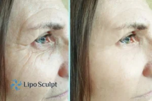 How to Fight Aging Symptoms 2 Do you want to Fight Aging Symptoms Burnt Tree? Contact Lipo Sculpt today!