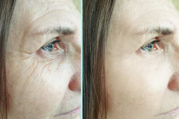 Why Do People Choose HIFU for a Non-Surgical Facelift? 4 How long can HIFU results last Burnt Tree?