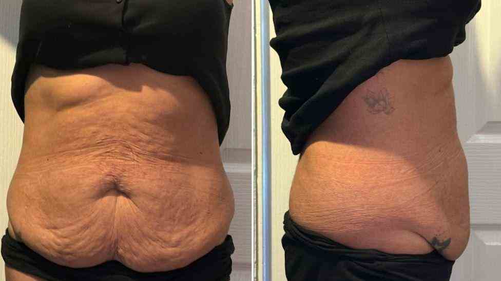 Lost the Weight but Not the Loose Skin? What You Should Know 1 Is It Definitely Loose Skin Burnt Tree?